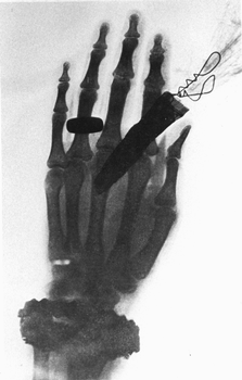 xray of a hand