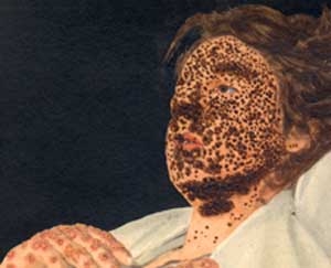 person with
              advanced smallpox